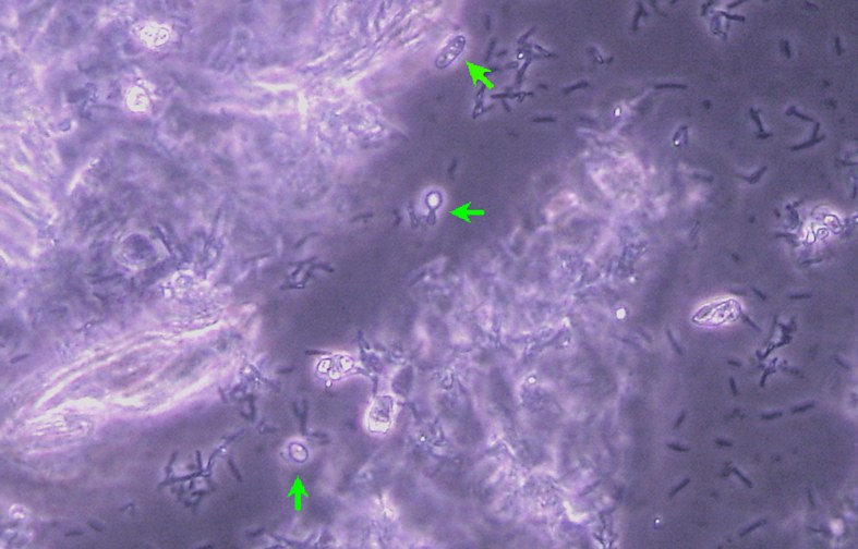 C.albicans–Vaginitis_Blastosporen